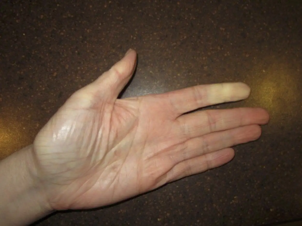 Raynaud’s Phenomenon