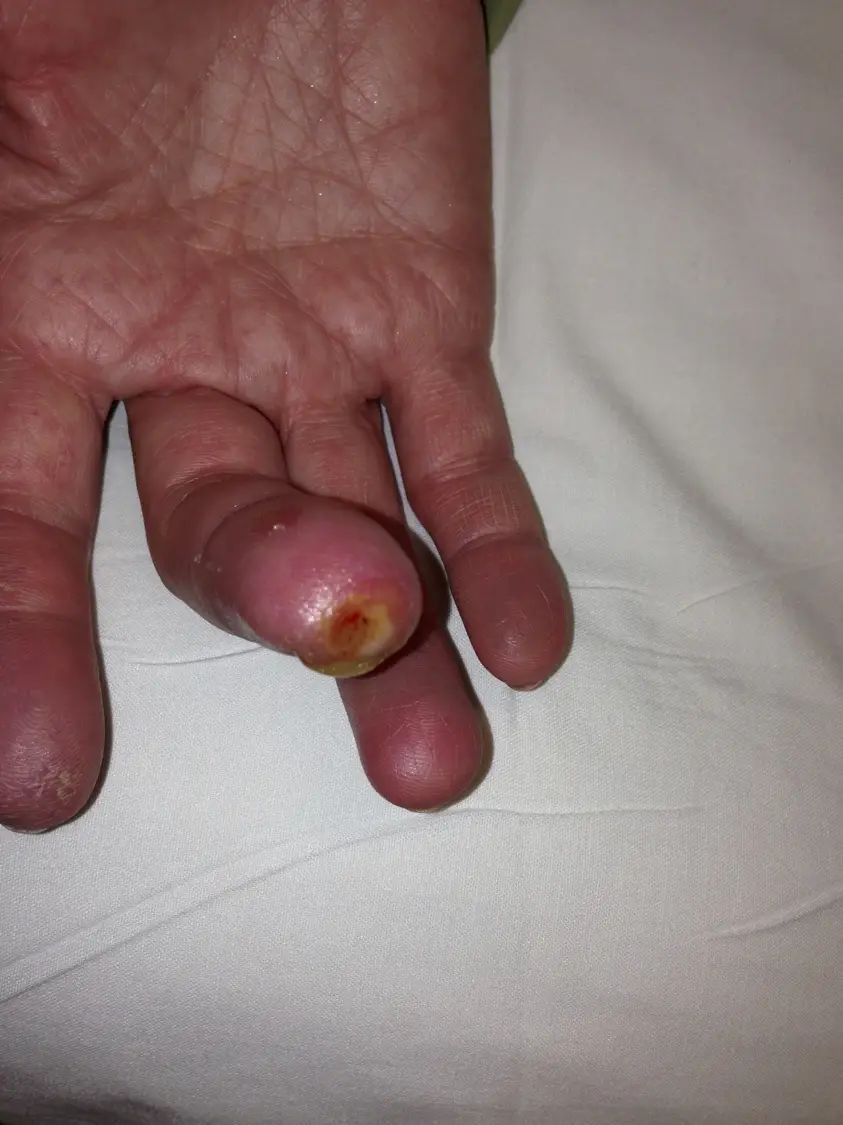 Ischemic Ulcer