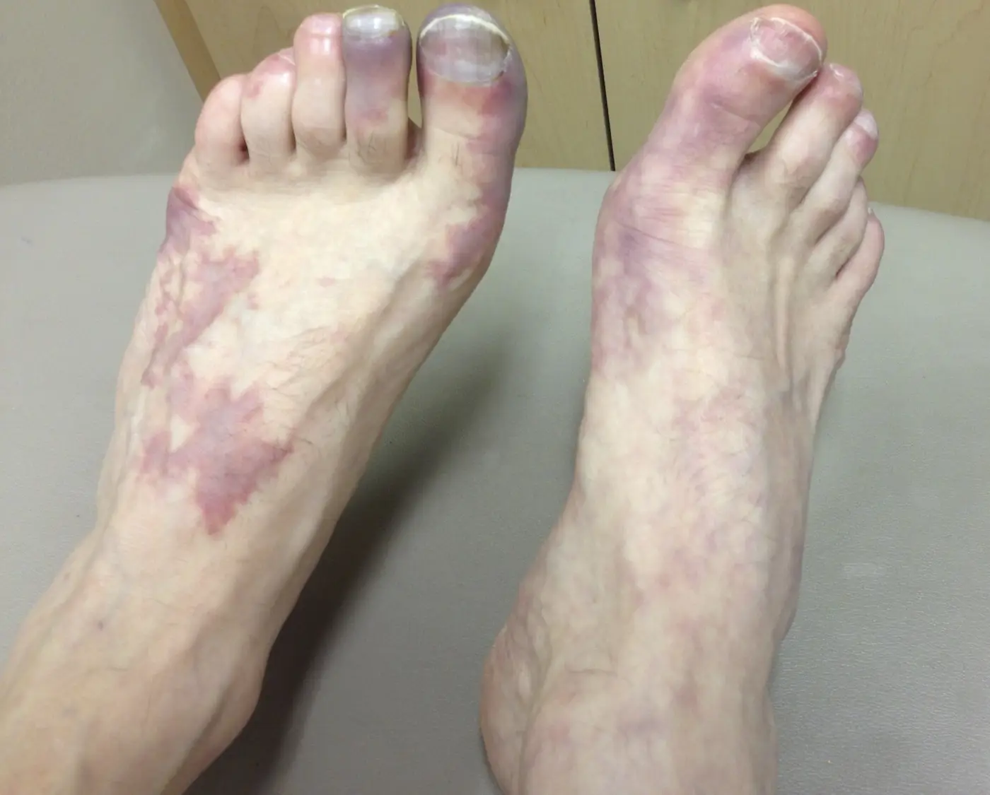 Angulated (Retiform) Purpura