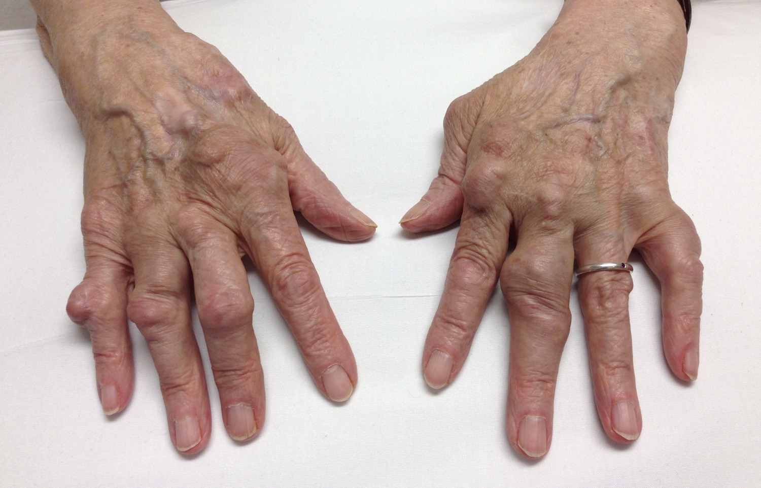 Rheumatoid Arthritis In The Hand RheumExam Atlas