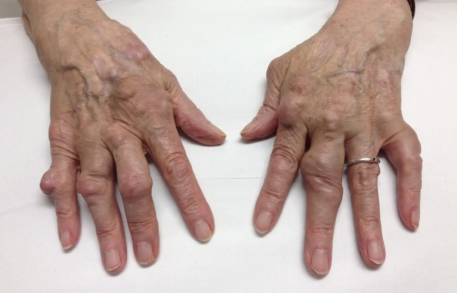 Rheumatoid Arthritis in the Hand