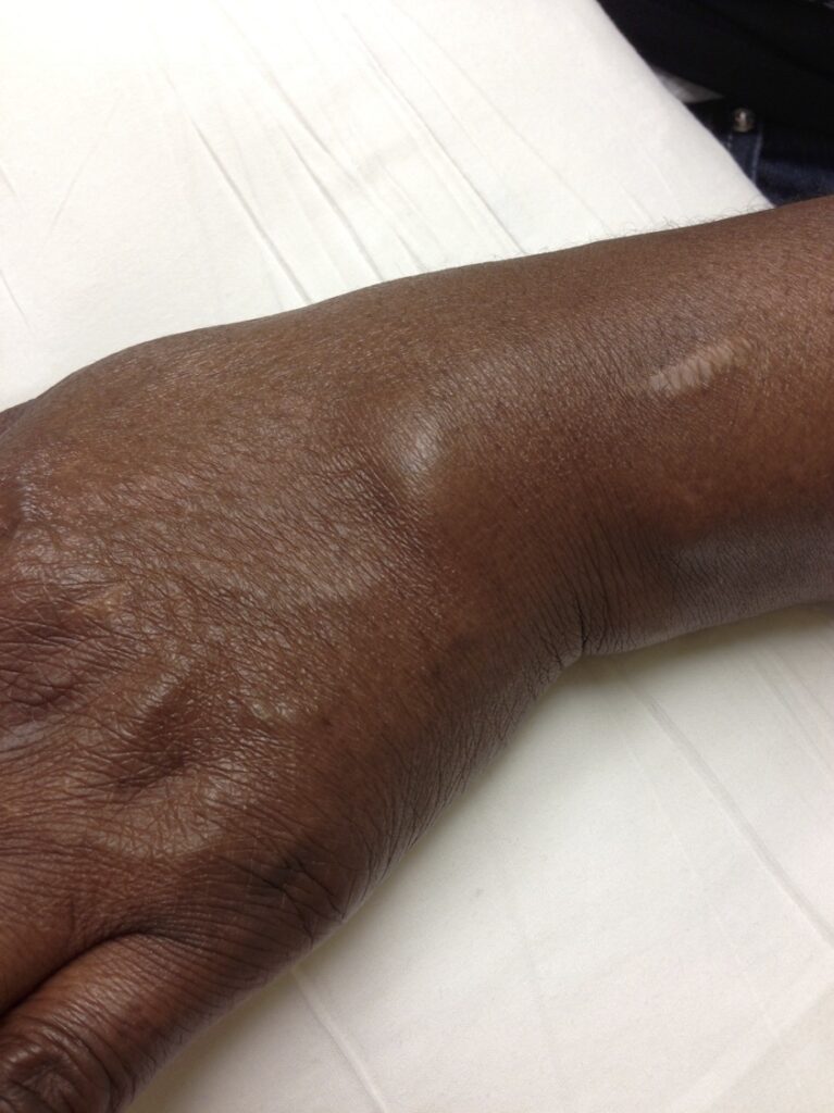 Tuck Sign – RheumExam Atlas
