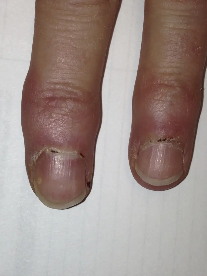 Small Vessel Vasculitis