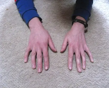 Inflammatory Arthritis in the Hand (After Treatment)
