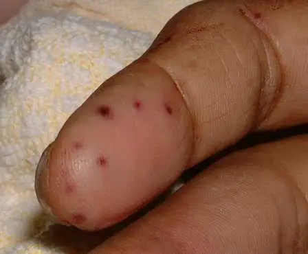 Vasculitis